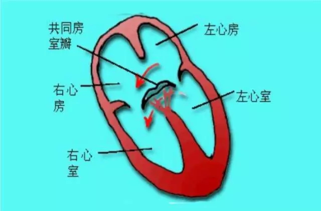 b型:二尖瓣和三尖瓣分开并可辨认,其腱索均与室间隔右心室侧相连.