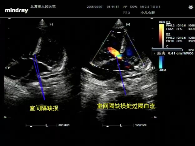 病例图片分享:完全性心内膜垫缺损