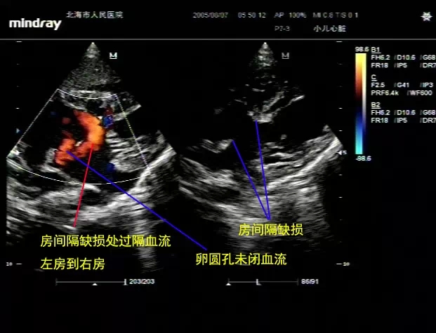 病例图片分享:完全性心内膜垫缺损