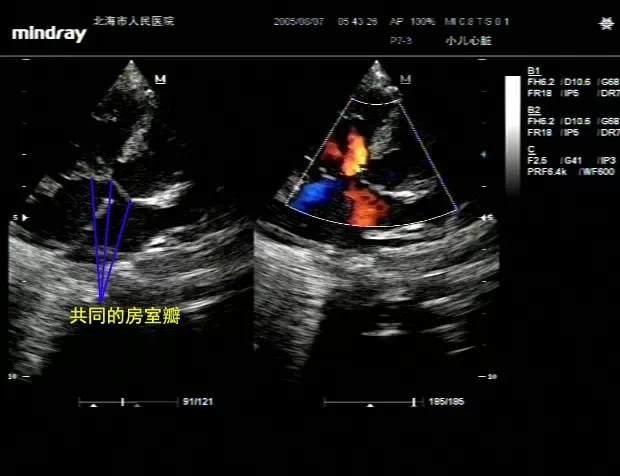 男性,1天,发绀1天 临床诊断:发绀查因,考虑先天性心脏病.