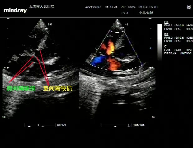 病例图片分享:完全性心内膜垫缺损